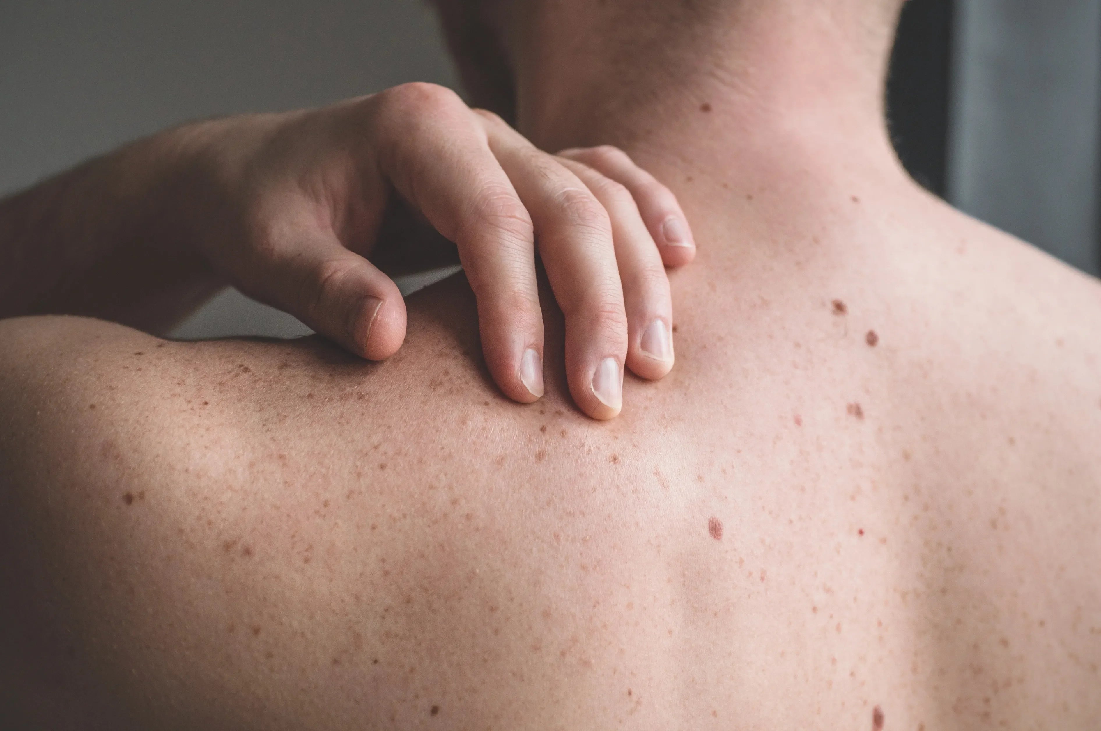 A person's back with moles