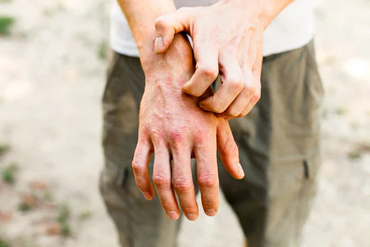 Hands with red itchy bumps