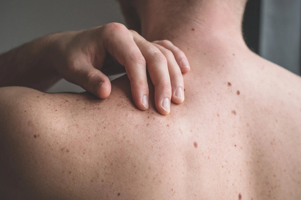 The ABCDE's Of Skin Cancer: Know Your Spots - Blue Lizard