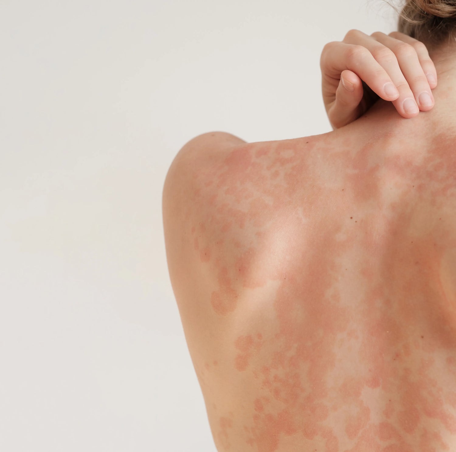 Person with a rash on their back.