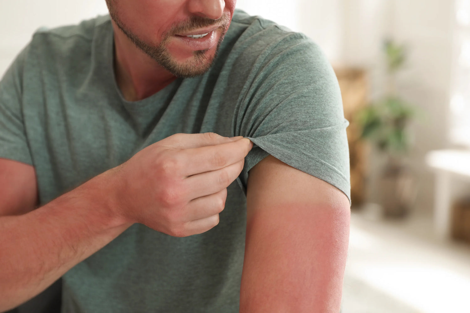 Man showing sunburned arm