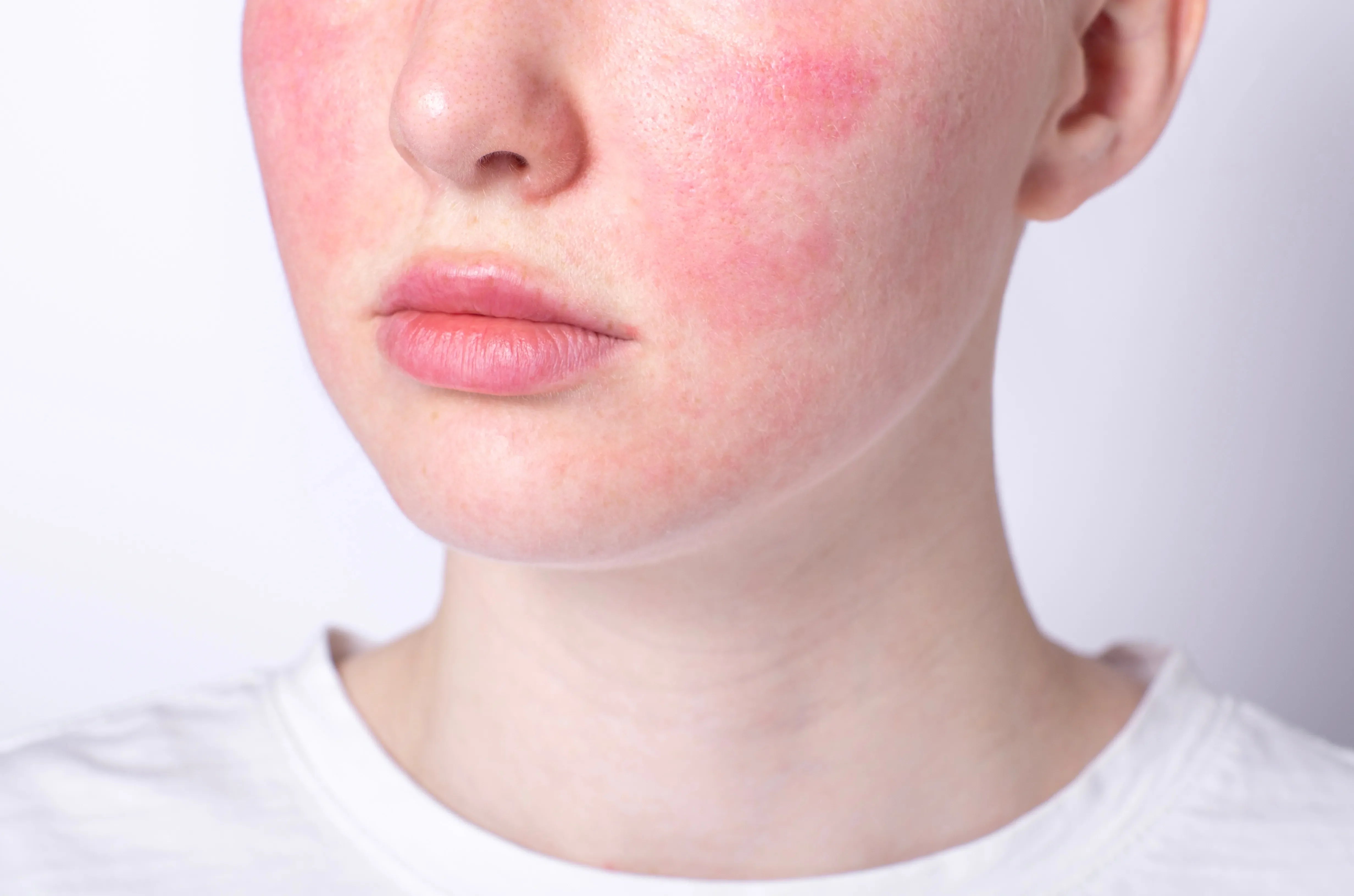 Close-up of a person's face with rosacea