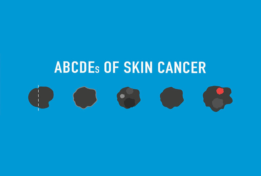 Know Your Spots: The ABCDE's of Skin Cancer