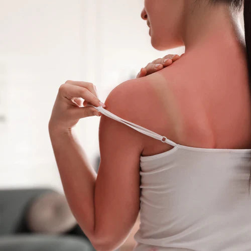 Woman with a sunburned back adjusting her strap